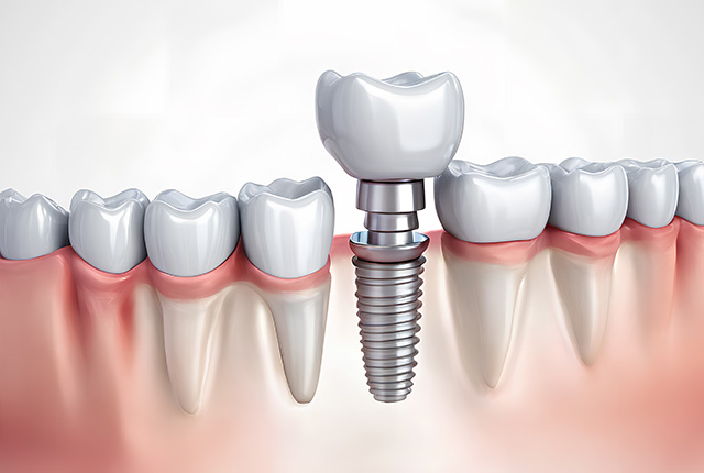 インプラント　イメージ画像