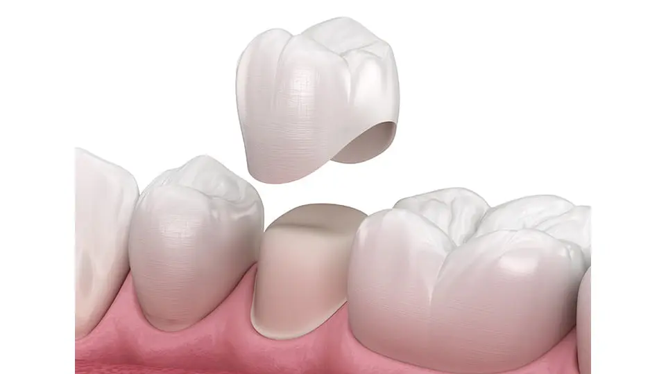 🦷キレイになるだけじゃない！セラミック治療のメリットについて🦷